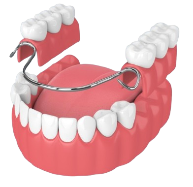 Partial dentures
